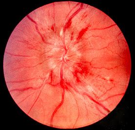 Papilledema - Wikipedia