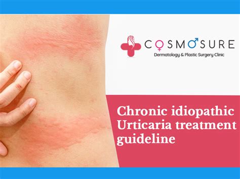 Chronic Idiopathic Urticaria Treatment Guidelines | Cosmosure Clinic