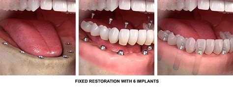 Full Mouth Dental Implants Stuart, FL | Teeth in a Day | Dr. James Horan