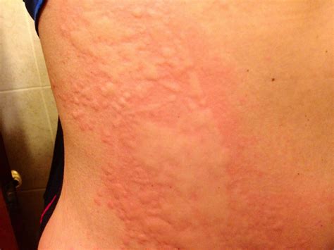 Pictures Of Hives Rash On Skin | Images and Photos finder