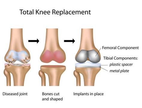 Orthopedic Total Joint Replacement