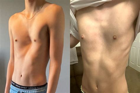 Vacuum bell treatment gets results for Oliver’s pectus excavatum