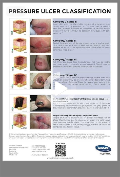 Medical surgical nursing- classify pressure ulcers | Medical surgical ...