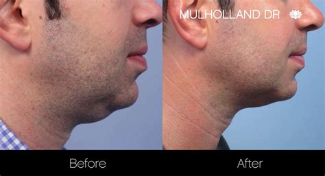 Toronto Double Chin Surgery for Men - Double Chin Removal