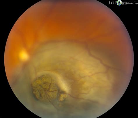 Choroidal Melanoma