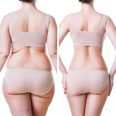 Skinny Shot Injections in Santa Rosa for Weight Loss