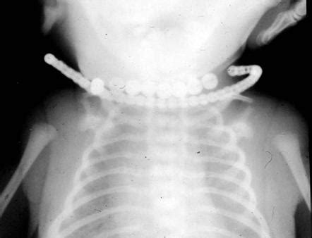 Campomelic dwarf | Radiology Case | Radiopaedia.org