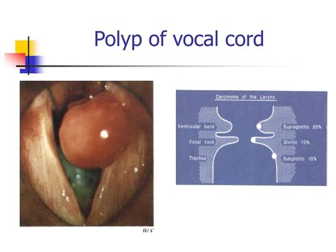 PPT - Head & Neck Cancers PowerPoint Presentation, free download - ID:3824798