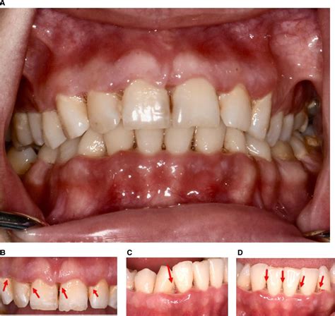 Necrotizing Ulcerative Gingivitis Vs Necrotizing Ulcerative Periodontitis