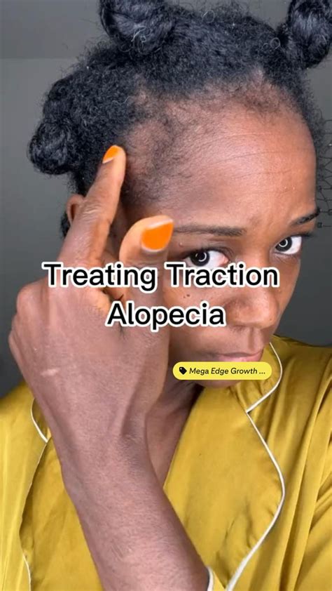 Traction Alopecia regrowth | Natural hair styles, Traction alopecia, Hair maintenance