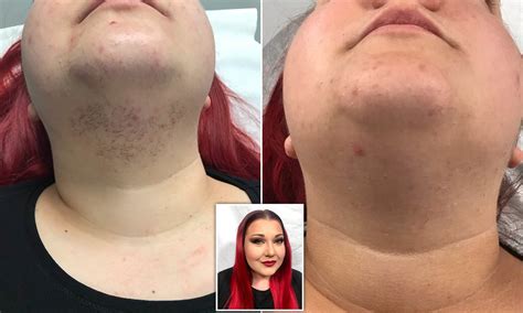 Update more than 68 female chin hair in 20s - vova.edu.vn