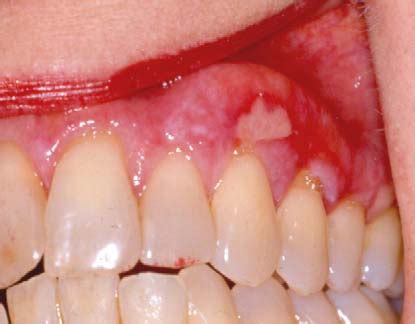 Oral Lichen Planus Causes, Symptoms, Prognosis, Diagnosis,, 56% OFF