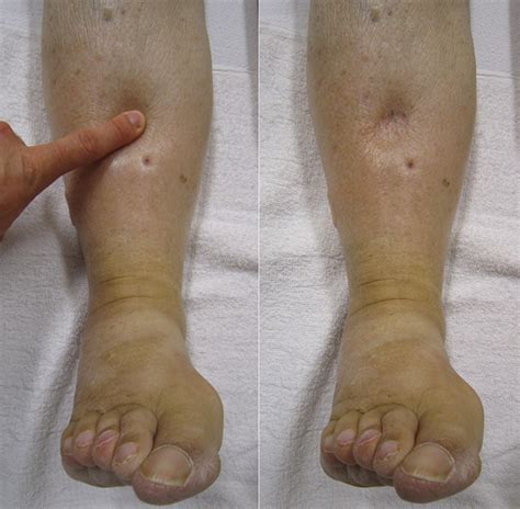 Leg Swelling Specialists in Maryland, New Jersey, and Virginia | Leg ...