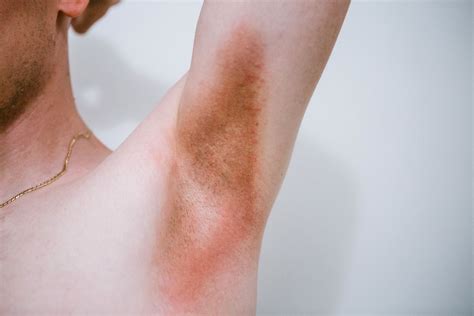 Fungal Infection Under Armpit