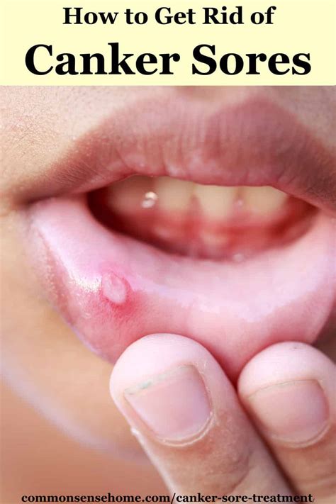 Canker Sore Treatment Salt