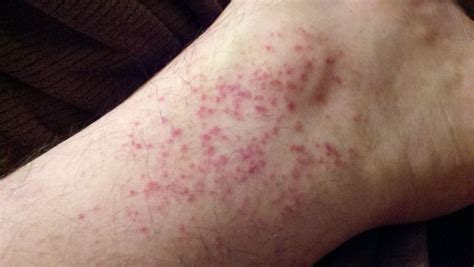 What Would Cause A Rash Around My Ankles at Grant Fusco blog