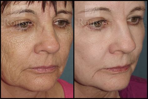Patient 2126625 | Chemical Peel Before & After | Rousso Facial Plastic ...