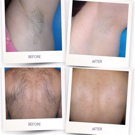 Permanent Hair Removal For Women Men, IMENE 500,000 Flashes IPL Permanent Hair Removal Upgrade ...