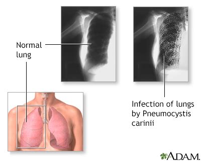 Pneumocystis jiroveci pneumonia Information | Mount Sinai - New York