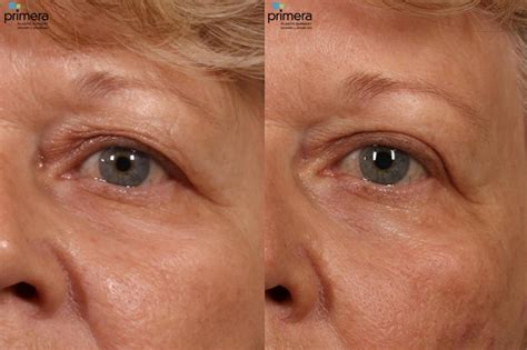 Blepharoplasty Before and After Pictures Case 16 | Orlando, Florida | Primera Plastic Surgery