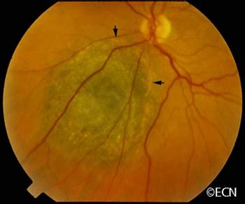 Case #2 — Tumors? In My Eyes?