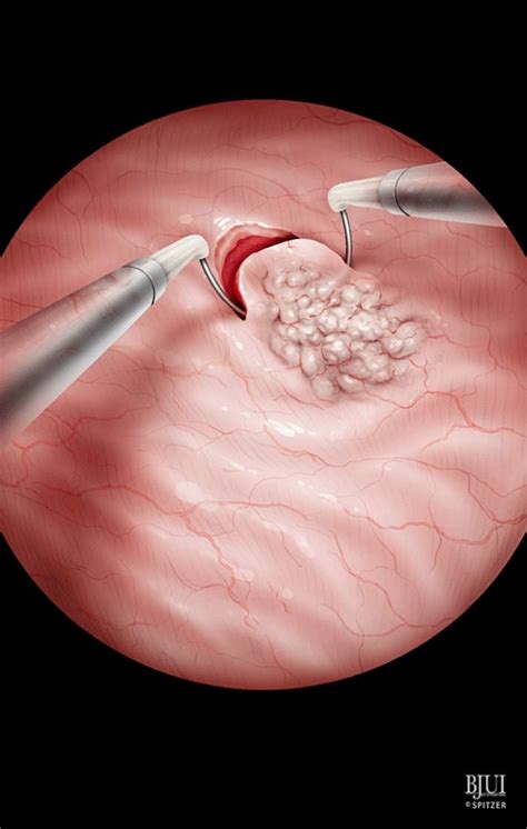 Transurethral Resection of Bladder Tumour Sydney | TURBT Procedure