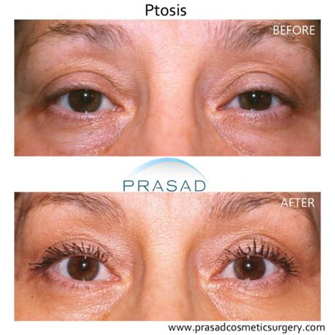 Droopy Eyelid Surgery: Eyelid Ptosis Procedure, and Recovery