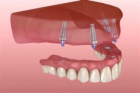 All-On-4 Implant Supported Dentures | Arkansas Periodontal and Implant Associates