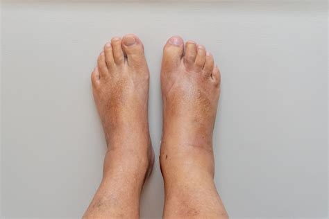 Left Foot Swollen On Top And Ankle Deals | emergencydentistry.com