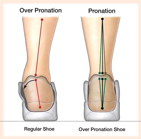 Overpronation Shoes: Are They Beneficial?
