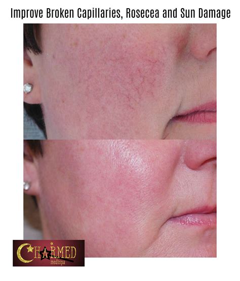 Broken Capillaries, Redness and Rosecea Dramatically Improved – Charmed ...