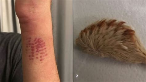 Florida teen lands in emergency room after encounter with venomous caterpillar | abc7.com