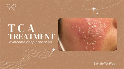 Overcoming Deep Acne Scars with TCA Treatment