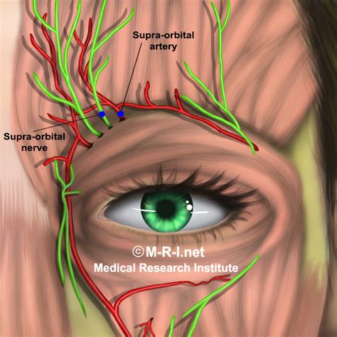 Supratrochlear Nerve Block