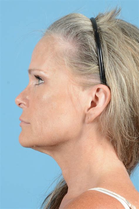 Patient 148646443 | Facial Augmentation Gallery | Dr. Henry A. Mentz