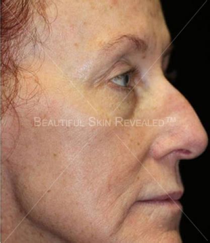 Photoaging Treatment Before and After Photos