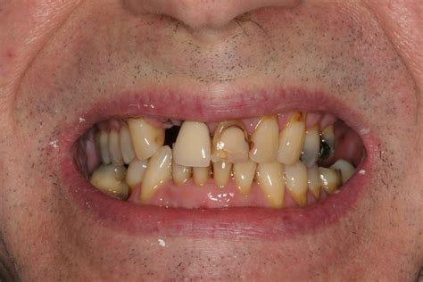 Before and After Dental Restoration Photos | West Bloomfield Dentist