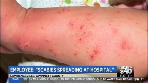 Scabies spreading at Lawrenceville hospital - YouTube
