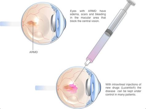 Age-related Macular Degeneration Treatment | Harley Street | Clinica London