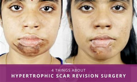 Four Things You Must Know About Hypertrophic Scar Revision Surgery – Richardson's Plastic ...