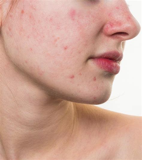 6 Simple Ways To Remove Red Spots On The Skin Red Spots On Face Skin ...