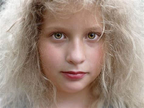 Uncombable Hair Syndrome: Causes, Treatment, and What It Is