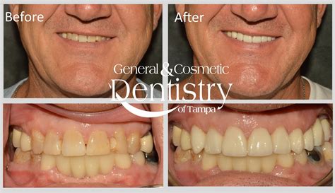 Before After Gallery | General and Cosmetic Dentistry of Tampa | Tampa, FL & Tampa, Fl