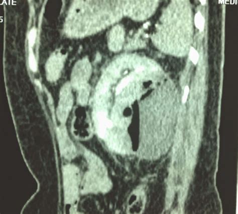 VIETNAMESE MEDIC ULTRASOUND: CASE 293: KIDNEY ABSCESS, Dr PHAN THANH HẢI, MEDIC MEDICAL CENTER ...