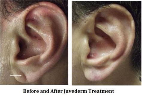 Ear Lobe Crease: Causes and Significance - Oli And Alex