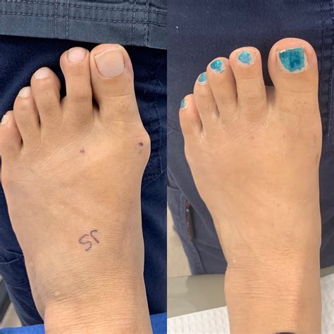 Before and After Bunion Surgery Photos | The Bunion Cure