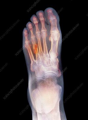 Fractured foot, X-ray - Stock Image - C006/8398 - Science Photo Library