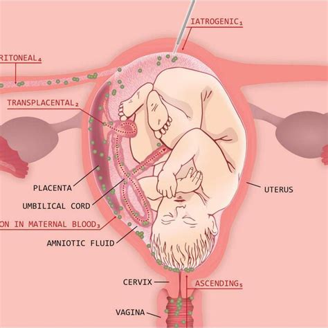 Management of clinical chorioamnionitis. | Download Scientific Diagram