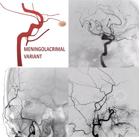 Subdural Hematoma Embolization | neuroangio.org