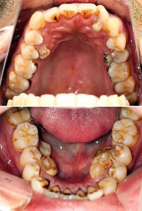 Hyperdontia - MEDizzy